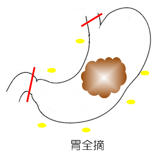 胃全摘