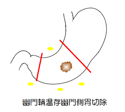 幽門輪温存幽門側胃切除