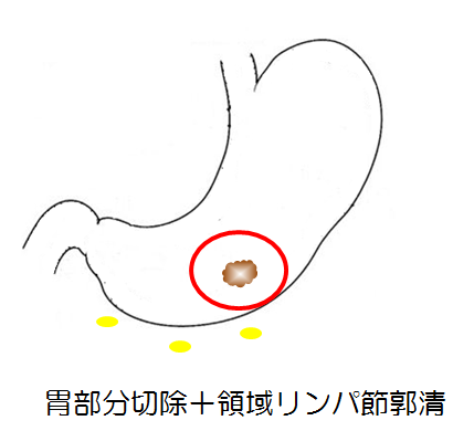 胃部分切除+領域リンパ節郭清