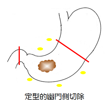 定型的幽門側切除
