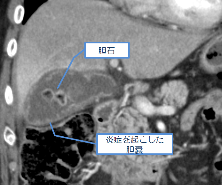 胆石・炎症を起こした胆嚢