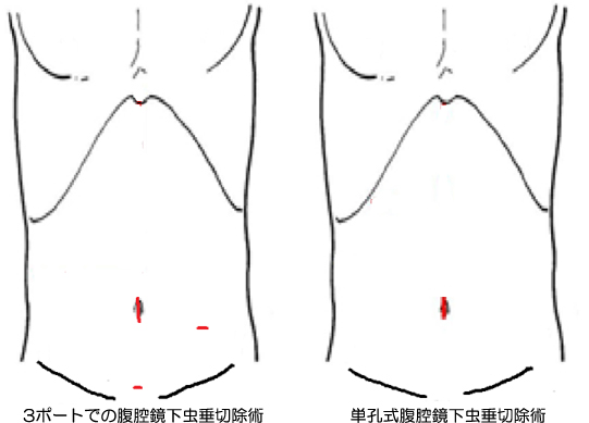 虫垂切除術で潰瘍性大腸炎を予防できますか?