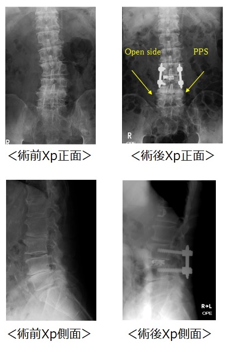 腰椎後方除圧固定術（MIS-PLIF：mono-portal PLIF）