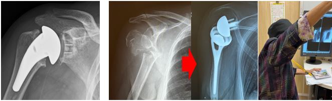解剖学的人工肩関節置換術