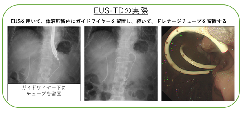 超音波内視鏡検査（EUS） | 診療科一覧 | 神鋼記念病院