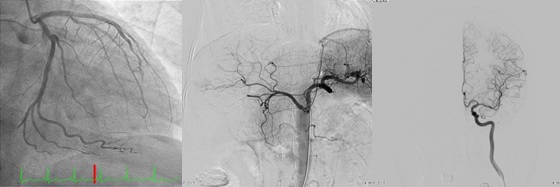 冠動脈造影/腹部血管造影/脳血管造影
