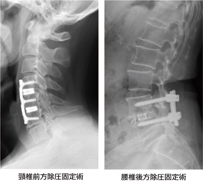 頸椎前方除圧固定術・腰椎後方除圧固定術