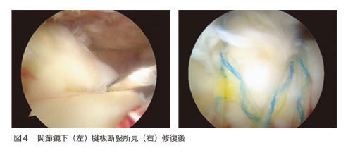 図4 関節鏡下（左）腱板断裂所見（右）修復後