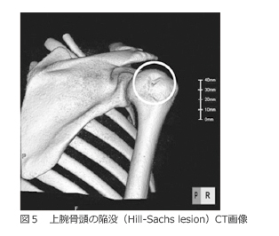 図5 上腕骨頭の陥没（Hill-Sachs lesion）CT画像